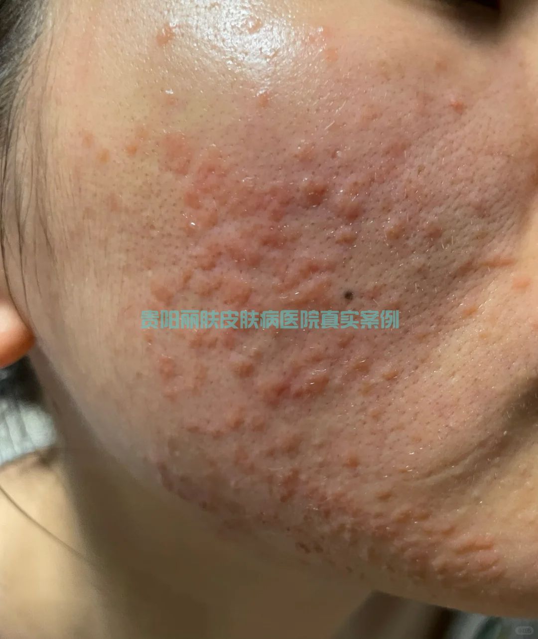 扁平疣案例