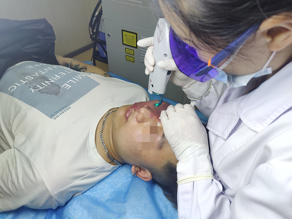 染料激光治疗鲜红斑痣_副本.jpg
