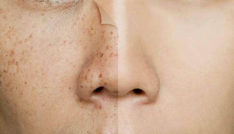 夏病冬治正当时，抓住冬季祛斑的好时机，告别满脸斑驳！