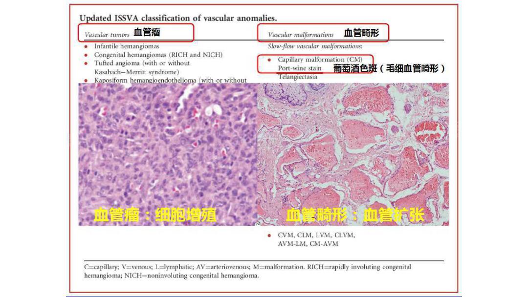鲜红斑痣怎样治疗可以快速消退“红斑”，选激光治疗需要多少次？