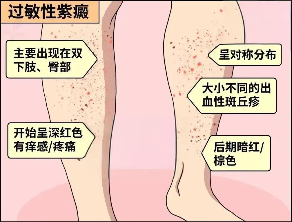 春天孩子要警惕过敏性紫癜，不只是皮肤长“红点点”